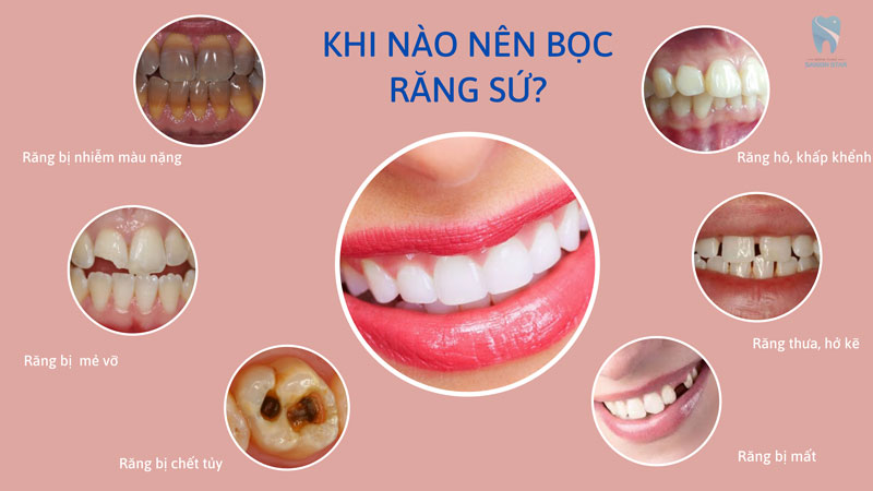 khi nảo nên bọc răng sứ