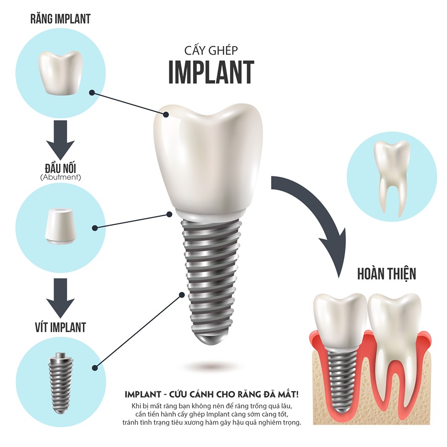 Đối tượng phù hợp Implant Tekka