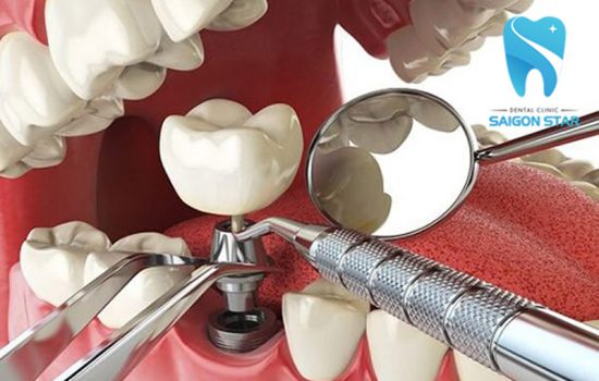 Quy trình trồng răng implant chuẩn y khoa cần tham khảo