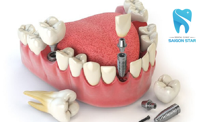 quy trình trồng răng implant