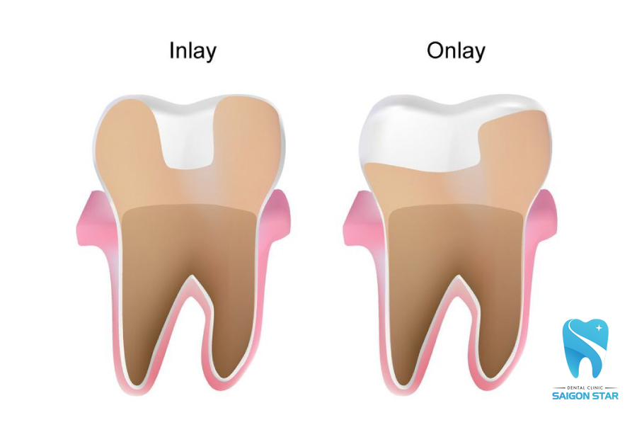 trám răng inlay/onlay là gì