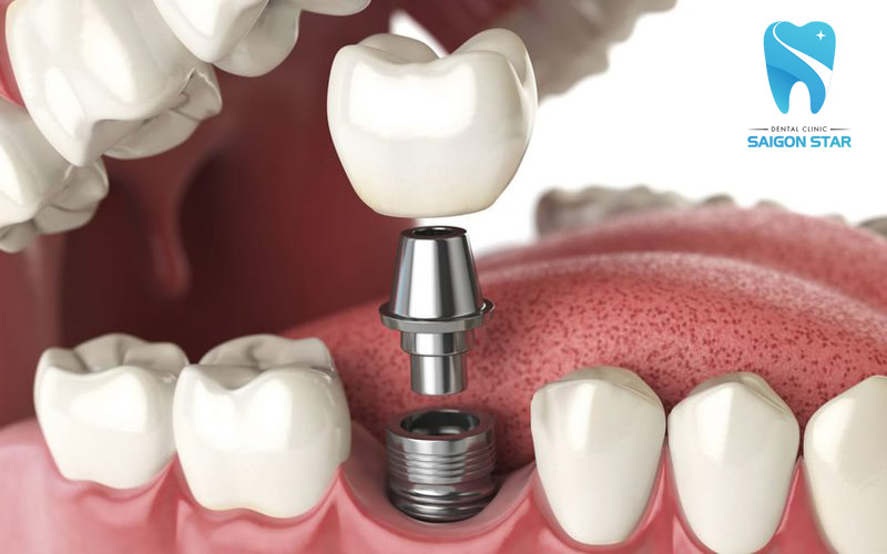 trồng răng giả giá rẻ bằng implant