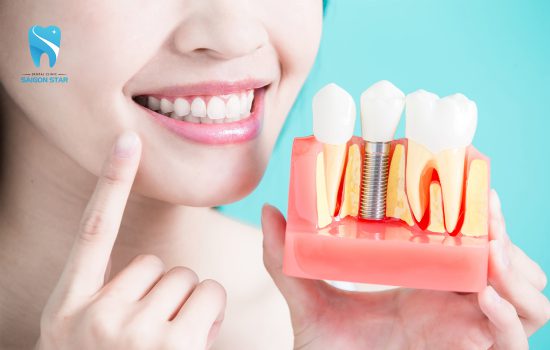 Trồng răng Implant là gì ?