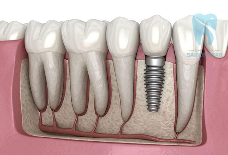 răng implant