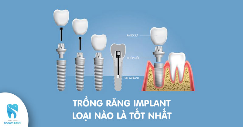 răng Implant loại nào tốt