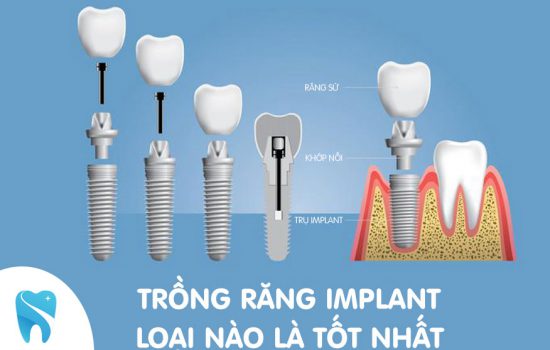 Răng Implant loại nào tốt? so sánh một số dòng trụ Implant trên thị trường