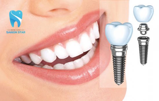 Trồng răng implant mất bao lâu