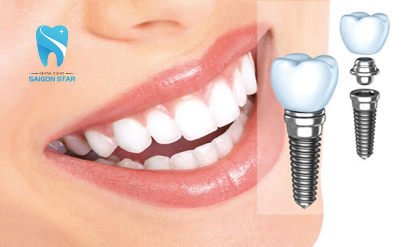 trồng răng implant mất bao lâu