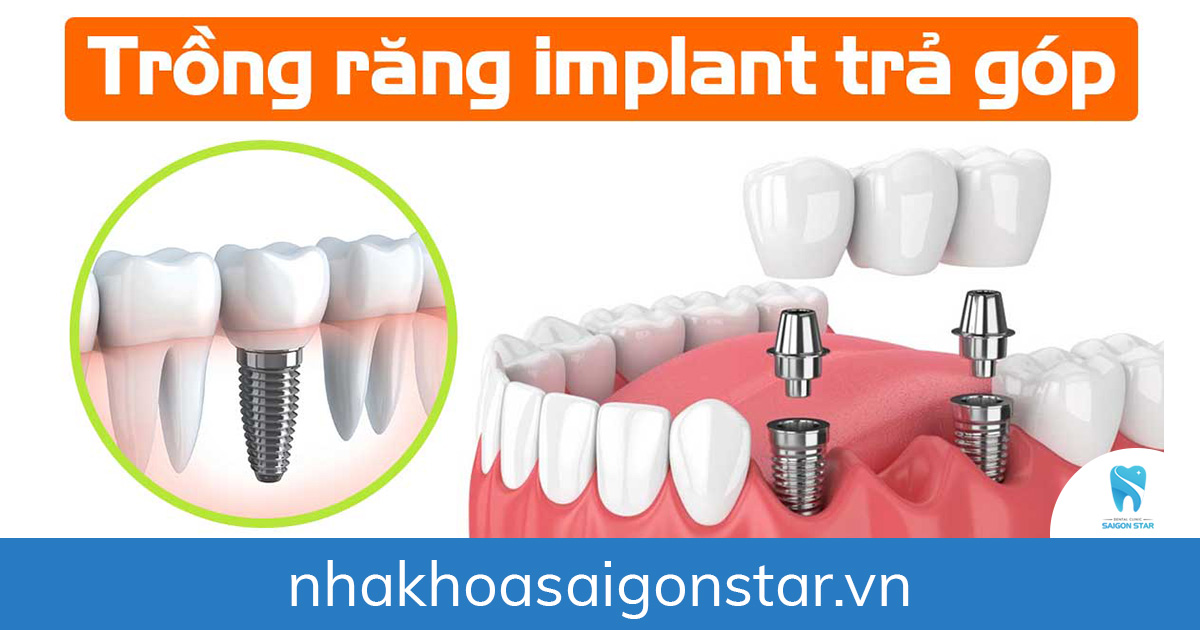 trồng răng implant trả góp