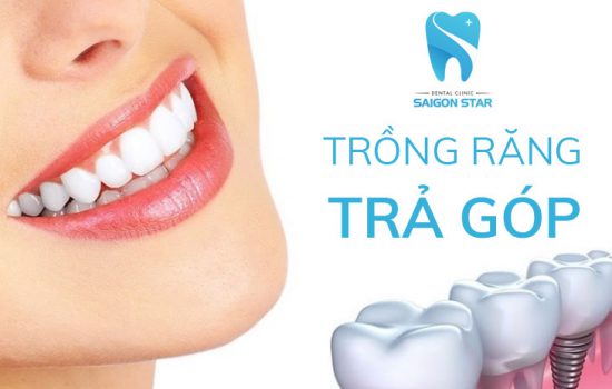 Trồng răng implant trả góp – giải pháp tối ưu chi phí trồng răng