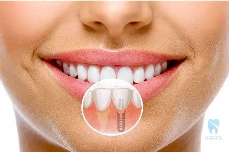 trụ implant hàn quốc