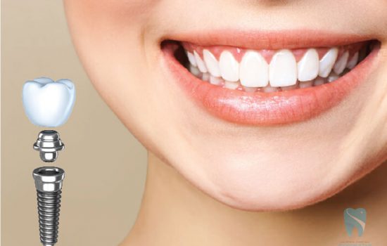 Trụ implant Hàn Quốc – ưu điểm của kẻ sinh sau đẻ muộn