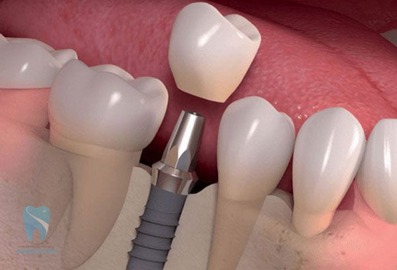 câu hỏi trụ implant hàn quốc