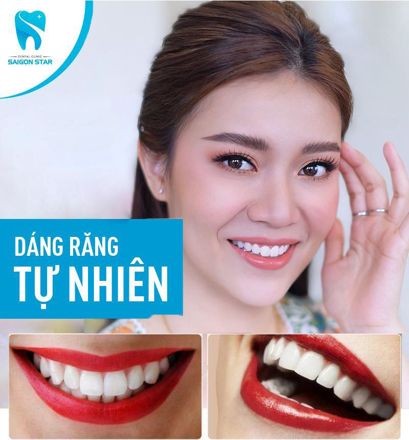 dán răng sứ giá bao nhiêu