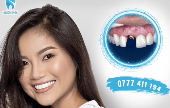 Những lưu ý trước và sau khi trồng răng implant để có kết quả tốt nhất