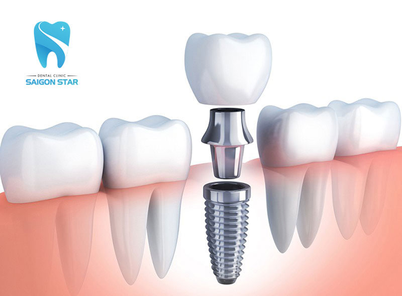 nhược điểm của trồng răng implant