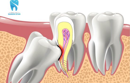 Giải đáp thắc mắc “răng ngầm là gì?” cùng bác sĩ