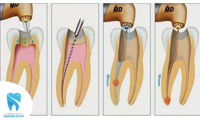 răng sâu vào tủy