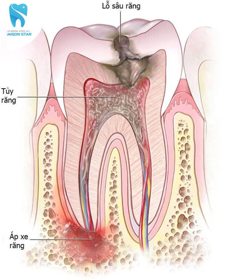 răng sâu vào tủy