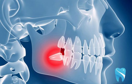 Những triệu chứng mọc răng khôn cần nhận biết sớm