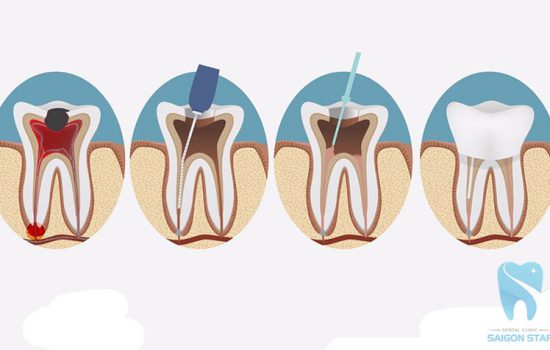 Tìm hiểu trám răng lấy tủy giá bao nhiêu?