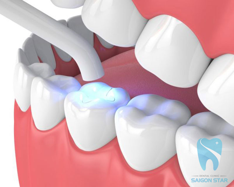 trám răng lấy tủy giá bao nhiêu