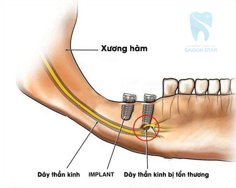 trồng răng implant có nguy hiểm không