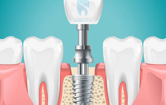 Trồng răng implant có nguy hiểm không? Những điều cần biết trước khi trồng răng