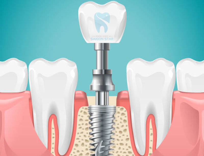 trồng răng implant có nguy hiểm không