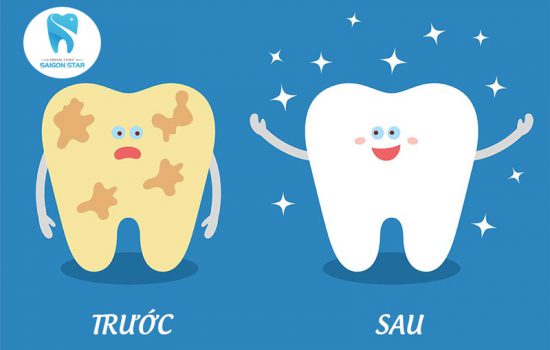 Bao lâu cạo vôi răng 1 lần? Cạo vôi răng có lợi ích gì?