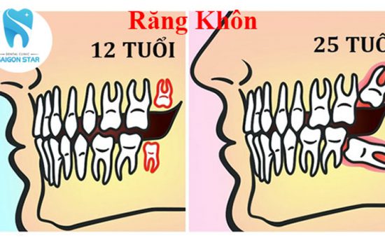 Bao nhiêu tuổi mọc răng khôn? Triệu chứng là gì?