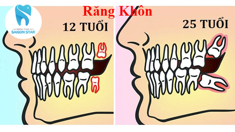 bao nhiêu tuổi mọc răng khôn