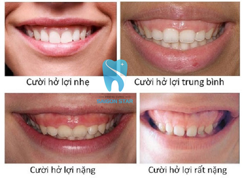 cười hở lợi là gì