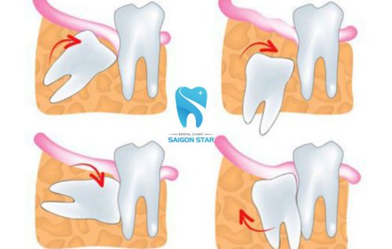 Dấu hiệu răng khôn mọc lệch và biện pháp xử lí kịp thời