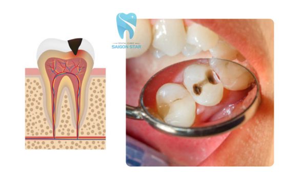 Những dấu hiệu sâu răng và biện pháp giải quyết hiệu quả