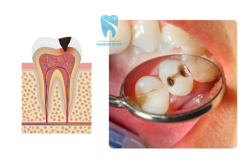 dấu hiệu sâu răng