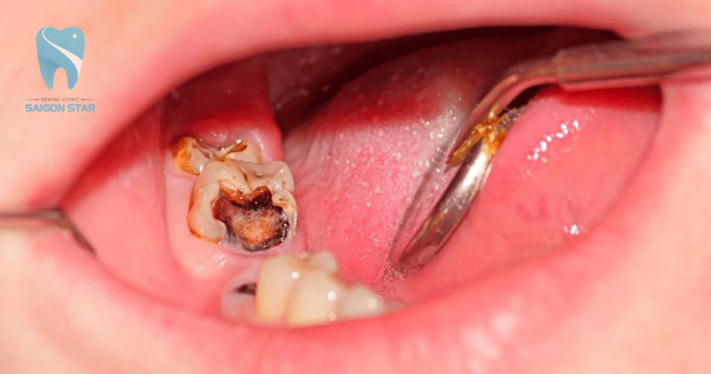 đau răng nên làm gì
