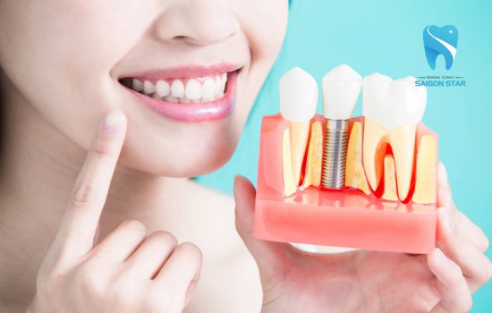 Lưu ý sau khi trồng răng Implant – theo ý kiến bác sĩ