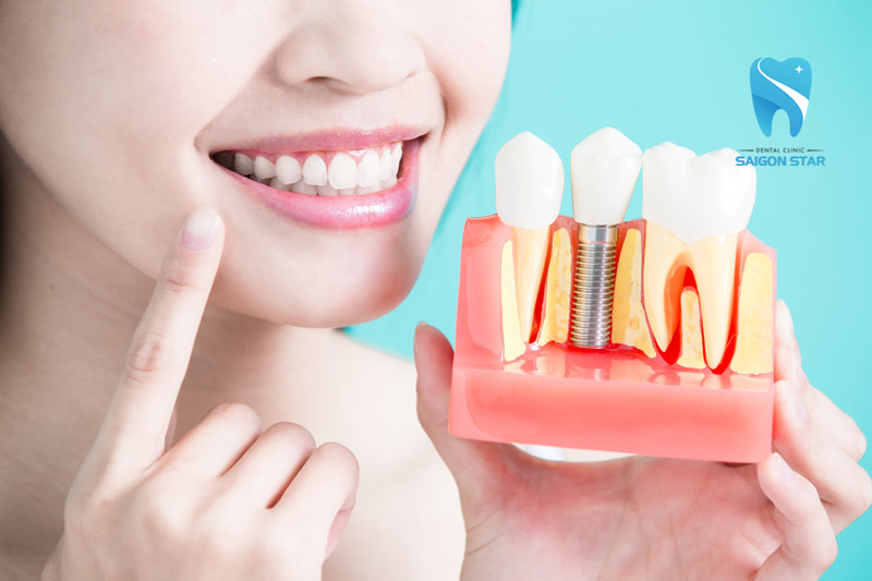 lưu ý sau khi trồng răng implant