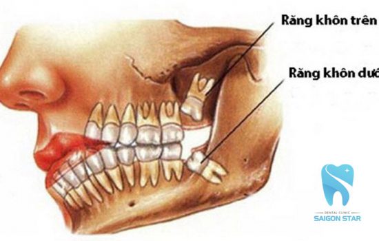 Mọc răng khôn hàm trên có triệu chứng gì? Nên nhổ không?