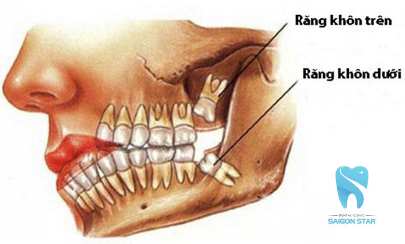 mọc răng khôn hàm trên