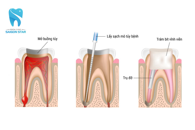 quy trình lấy tủy răng