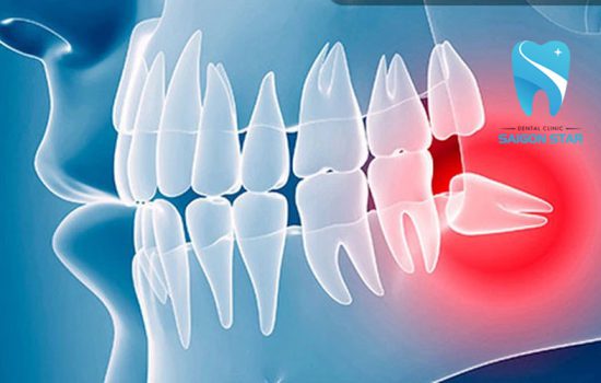 Răng khôn mọc khi nào? Triệu chứng mọc răng khôn là gì?