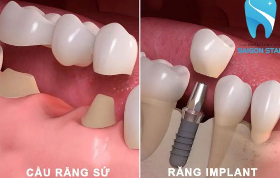 Trồng răng giả cố định gồm mấy loại? Nên chọn loại nào?