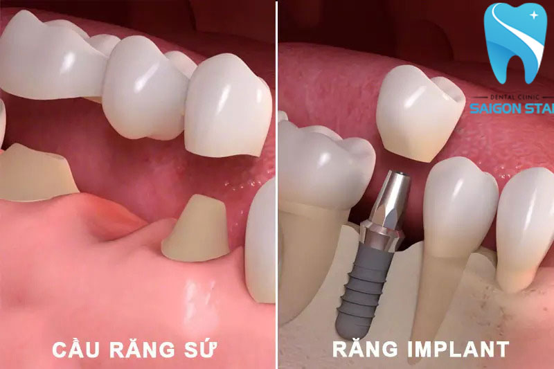 trồng răng giả cố định