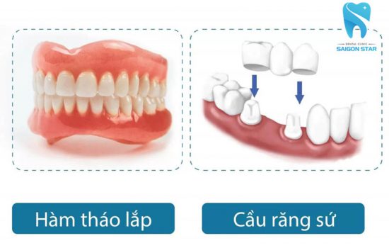 Trồng răng sứ không có chân răng – những điều bạn nên biết