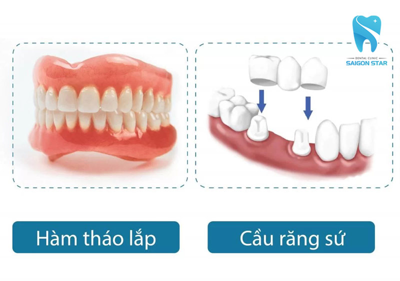 trồng răng sứ không có chân răng