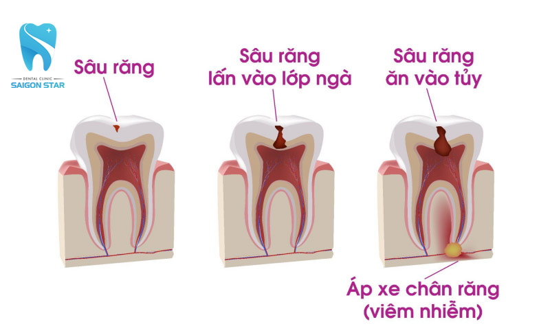 viêm chân răng có mủ