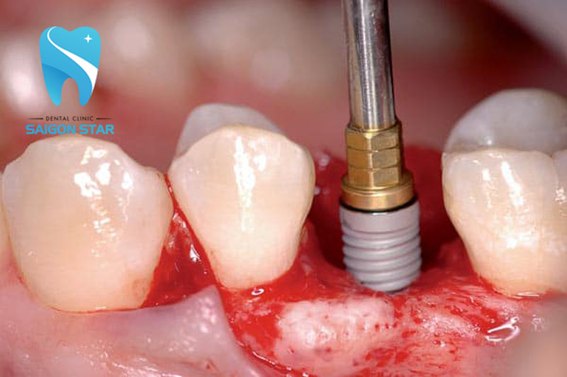 biến chứng trồng răng implant