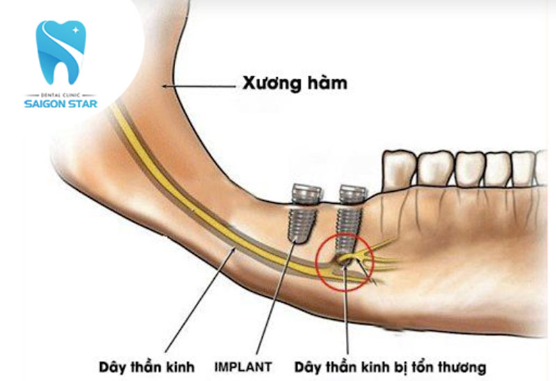 biến chứng trồng răng implant